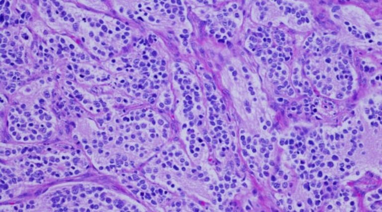 Scopri di più sull'articolo P-182-miRNA494 downregulation increases neuroblastoma sensivity to oxidative stress